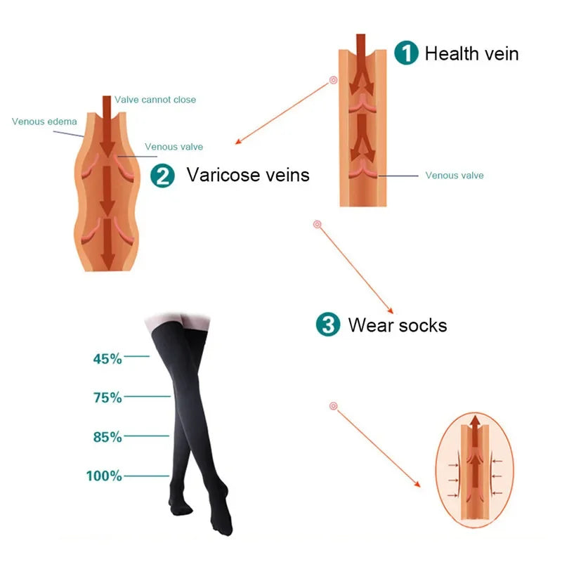 Open-Toe Graduated Compression Stockings 30–40 mmHg