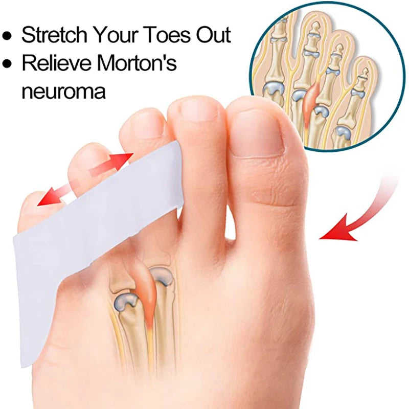 Toe Separators for Overlapping Toes