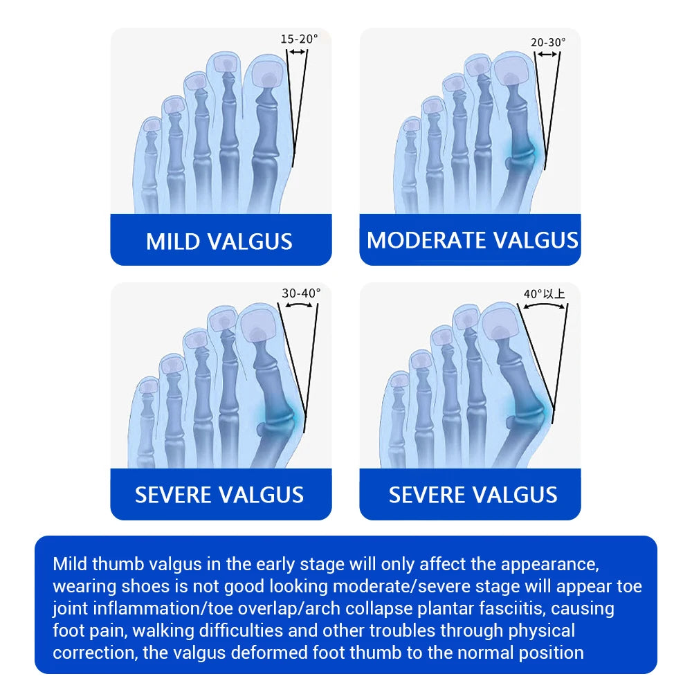Big Toe Bunion Splint
