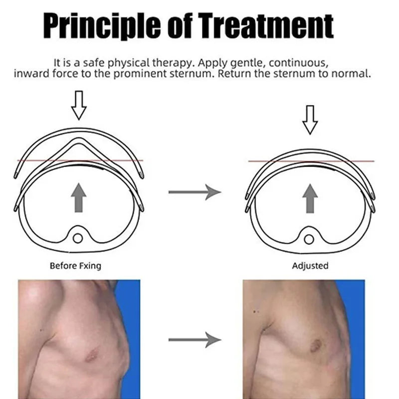 Adjustable Chest Orthosis Brace