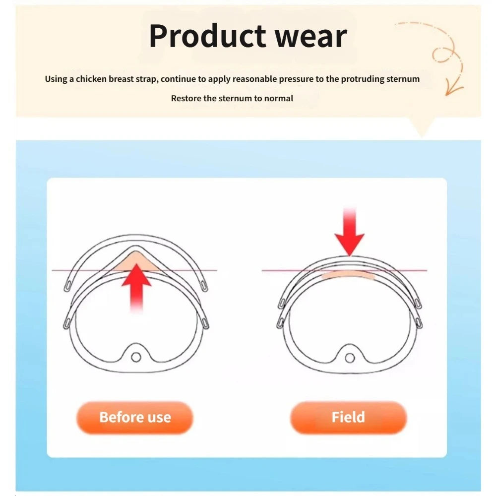 Adjustable Pectus Carinatum Orthosis Brace